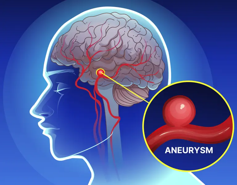 Kim Kardashian Brain Aneurysm
